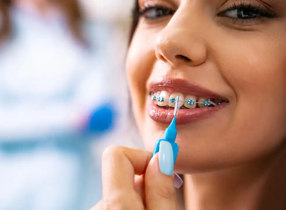 Recommended Braces Hygiene Tips for a Cleaner Smile